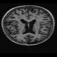 Brain MRI Image